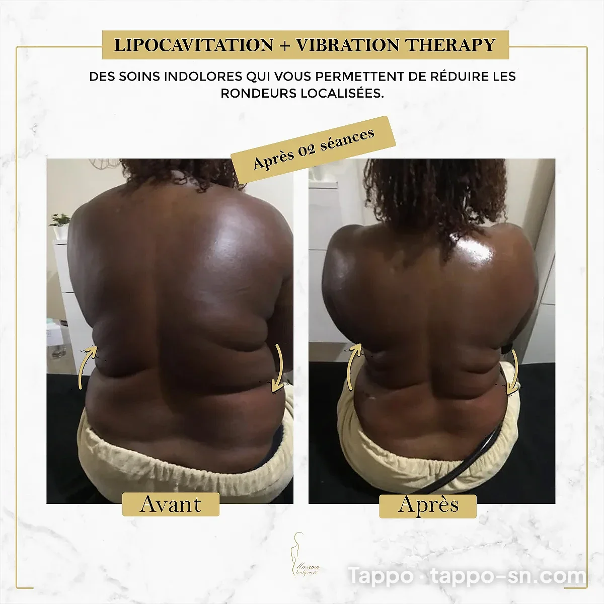 Soin lipocavitation et vibration therapy à Dakar - Sacré-Cœur – photo 1